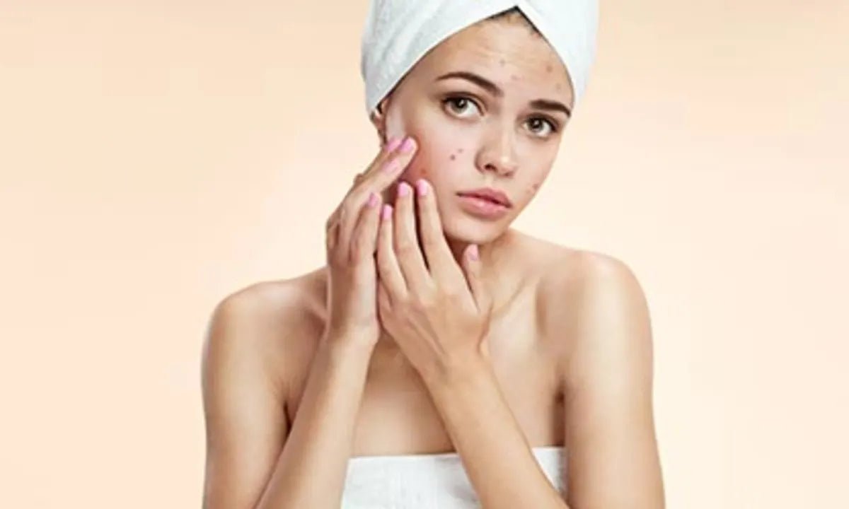 How to Avoid Pimples? Simple Habits Can Help You - snowyskinco